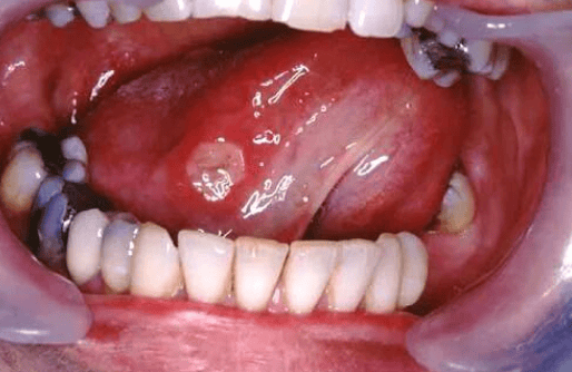 白塞氏病 反复口腔溃疡竟是“信号弹”？这些症状千万别忽视