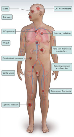 一名 32 岁男性出现精神错乱、头痛和发烧 白塞氏病病例分析