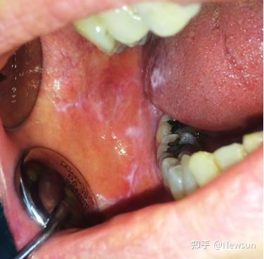 口腔扁平苔藓与白塞氏病 症状、诊断与治疗全解析