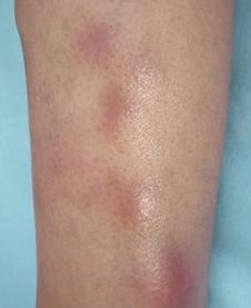 白塞病是否容易被误诊 探究白塞氏病的诊断挑战