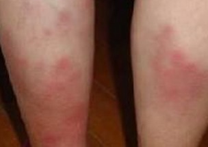 应对白塞病贫血 全面认识与科学管理策略