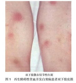 再生障碍性贫血并发白塞病1例分析