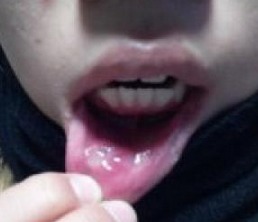 白塞病的检查方法与诊断流程