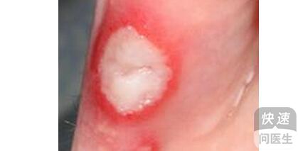 警惕反复口腔溃疡——深入认识白塞病的症状与警示