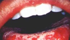 白塞病（白塞氏病）的非激素治疗策略与综合管理